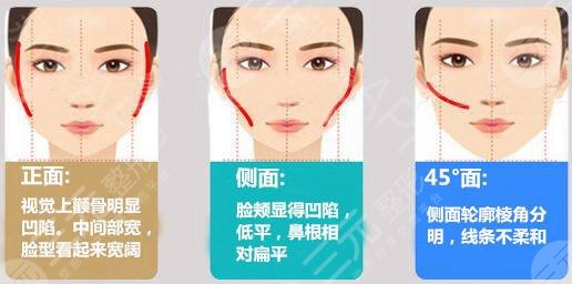 颧骨颧弓缩小手术