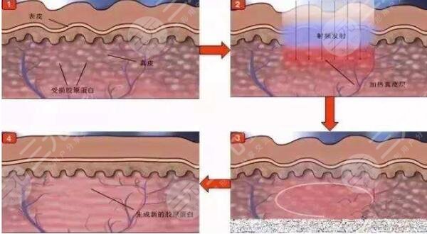 复合彩光嫩肤原理介绍