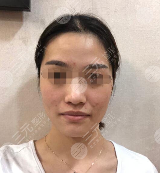 复合彩光嫩肤案例前