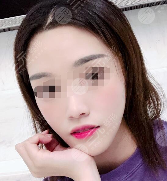 复合彩光嫩肤案例后