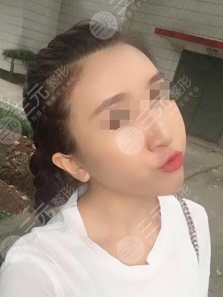 注射美白真人果后