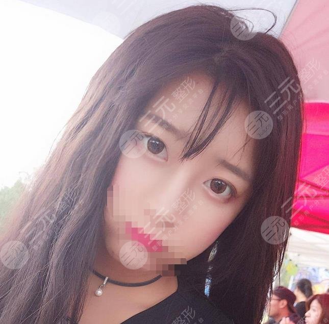 堵顶云双眼皮案例