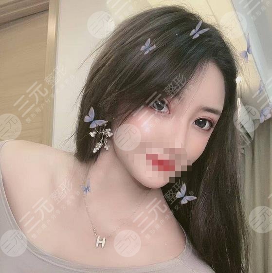 堵顶云双眼皮案例