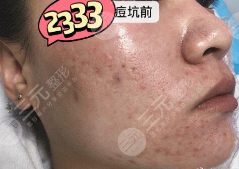 上海九院点阵激光后恢复过程图祛痘印果太赞了
