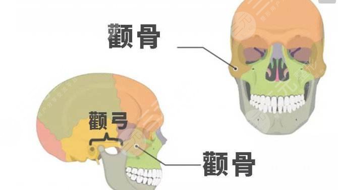 磨颧骨手术简介