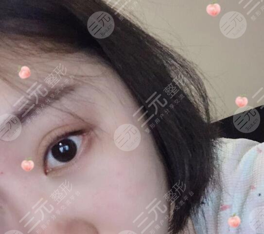 埋线20天恢复图:动感传神|自然放大|闭眼隐痕