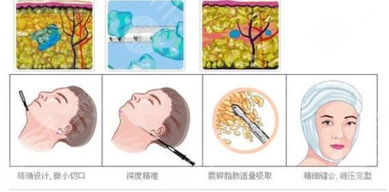 光纤溶脂瘦脸术后护理