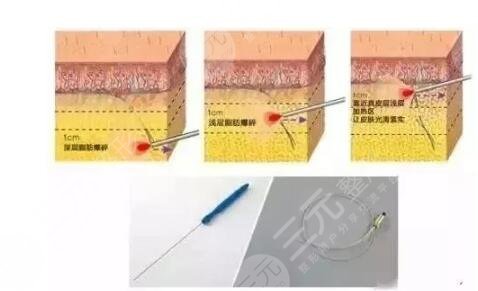 光纤溶脂瘦脸是*的吗?