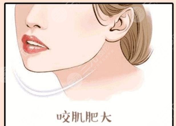 咬肌切除手术风险大么