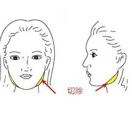 咬肌切除手术风险大么