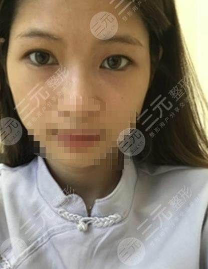 河北医科大学第一医院整形美容科双眼皮案例图