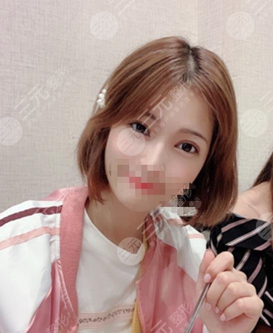 河北医科大学第一医院整形美容科双眼皮案例图