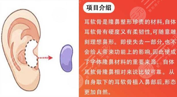 隆鼻手术