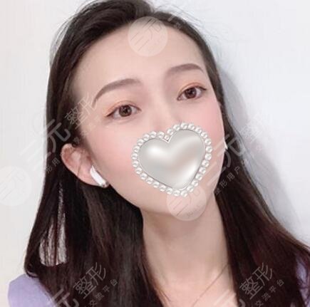 注射瘦脸前后对比图
