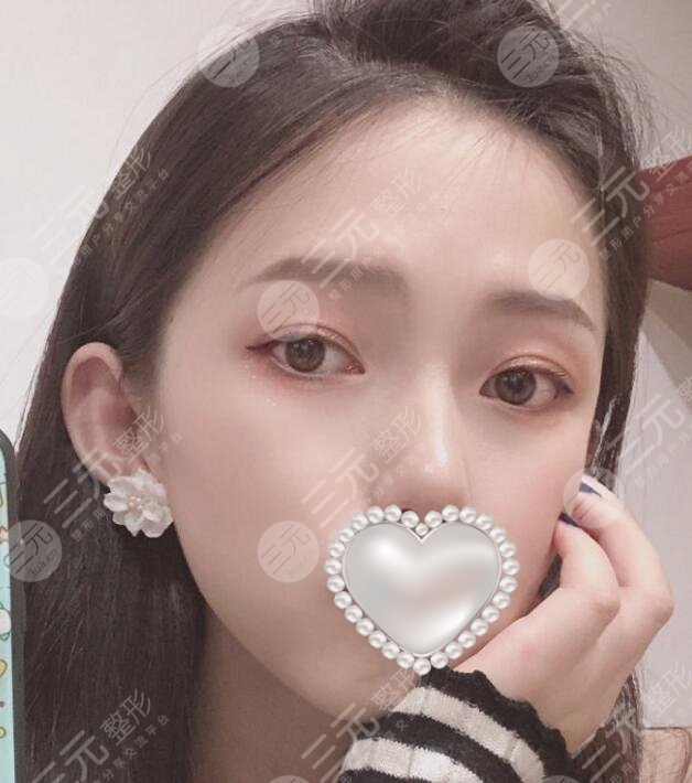 注射瘦脸前后对比图