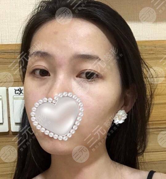 注射瘦脸前后对比图