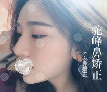 驼峰鼻矫正图片|驼峰鼻怎么改良|多久恢复|术前必备攻略！