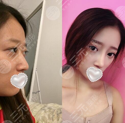 驼峰鼻矫正图片