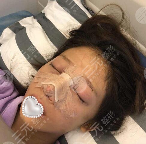 驼峰鼻矫正图片