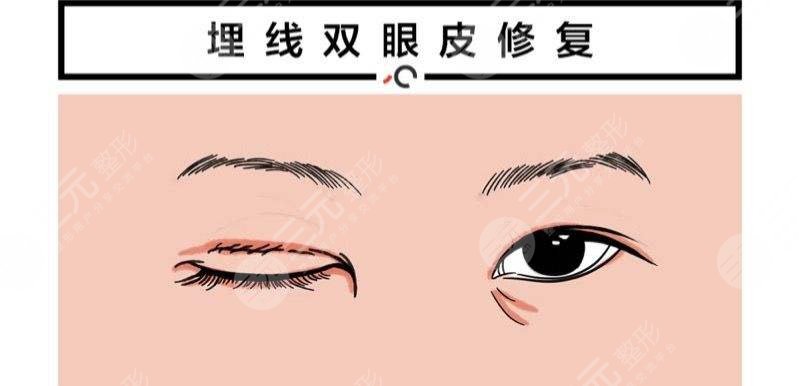 埋线术后恢复过程图