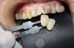 做烤瓷牙要多长时间？过程是怎样的？附烤瓷经历