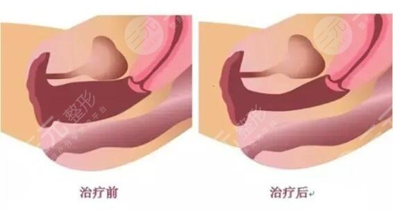 Fotona欧洲之星微创私密契约激光的缓解原则