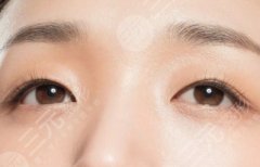 割双眼皮修复多少钱？同院还要收钱吗？