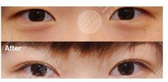 双眼皮做哪种好看？好看的双眼皮案例