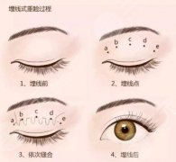 埋线双眼皮图片，十天恢复图及经历