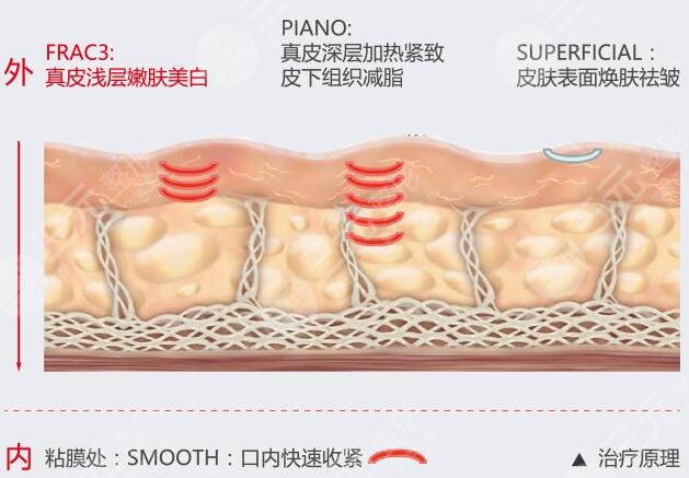 什么是火凤凰溶脂