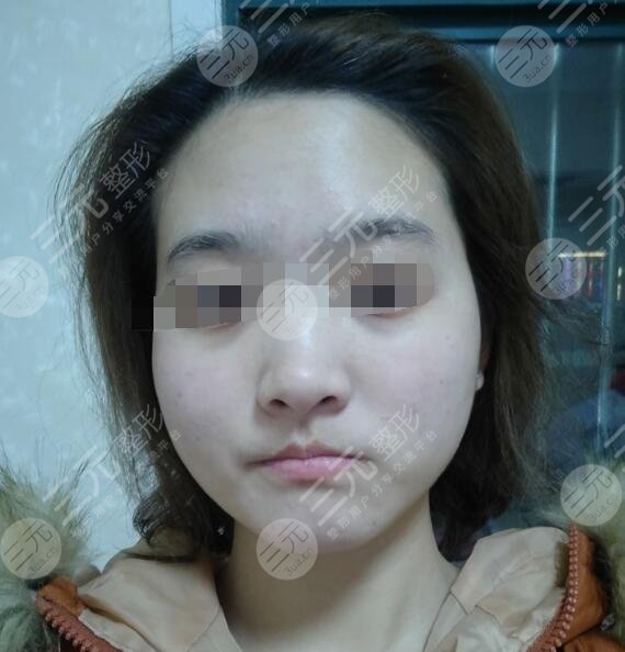 火凤凰溶脂真实果前