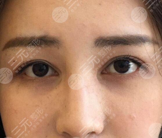 曹仁昌修复内眼角案例前