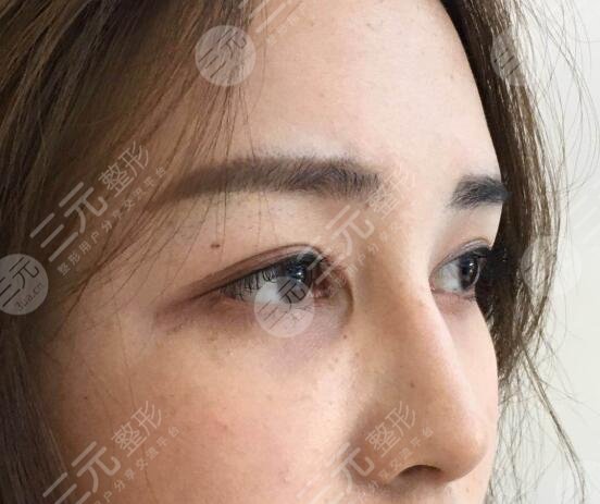 曹仁昌修复内眼角案例