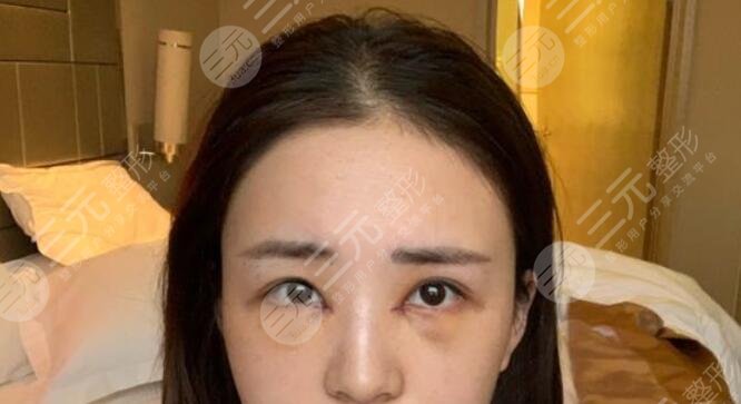 曹仁昌修复内眼角案例后一周