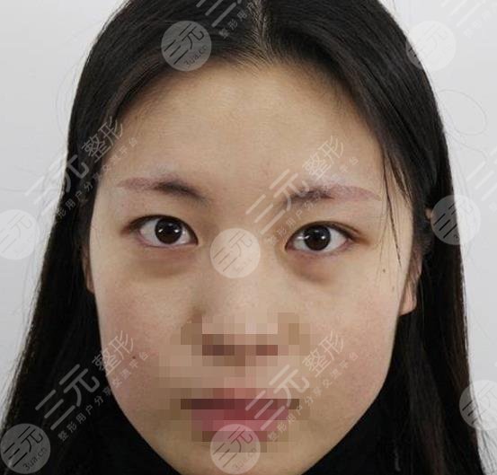 哈医大一院整形美容中心激光去眼袋