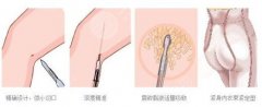 光纤溶脂瘦大腿果怎么样？多久才会消肿？