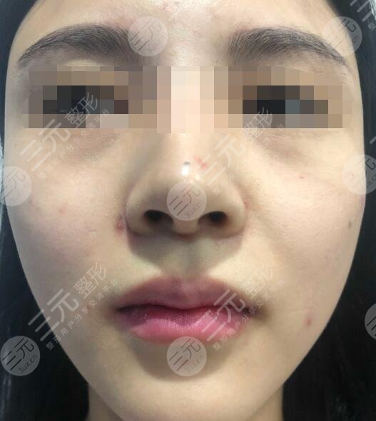 火凤凰溶脂真人案例前
