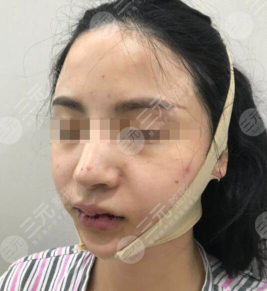 火凤凰溶脂真人案例后一周