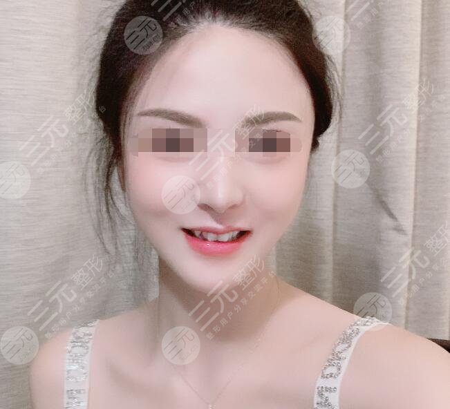 火凤凰溶脂真人案例后4周