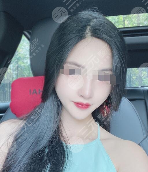 火凤凰溶脂真人案例后8周