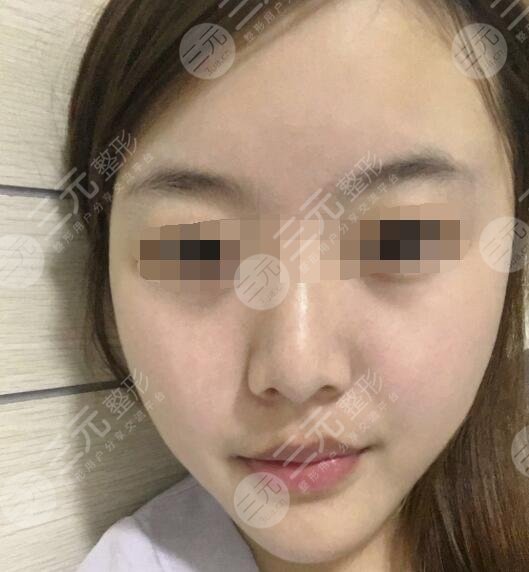 火凤凰仪器溶脂面部溶脂案例反馈后2周