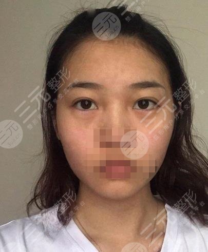 重庆当代整形医院去眼袋果图
