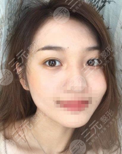 重庆当代整形医院去眼袋果图