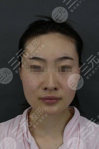 山大二院美容整形外科脸部下颌骨果图
