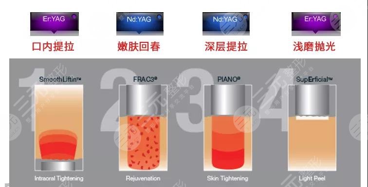 德国fotona4d原理