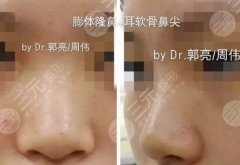 自软骨隆鼻和假体隆鼻哪个贵？区别+自体隆鼻案例