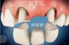 纯钛烤瓷牙一般多少钱一颗？为了美容该做烤瓷牙吗？