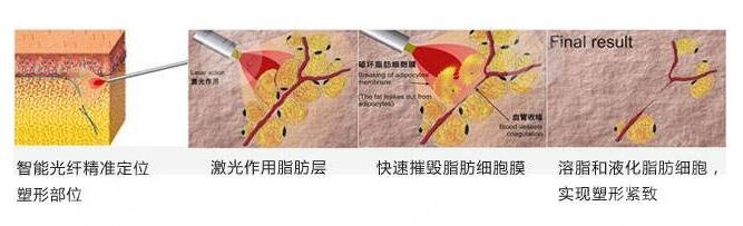 欧洲之星火凤凰纤体溶脂优势解析