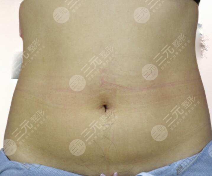 欧洲之星火凤凰纤体溶脂塑形案例前