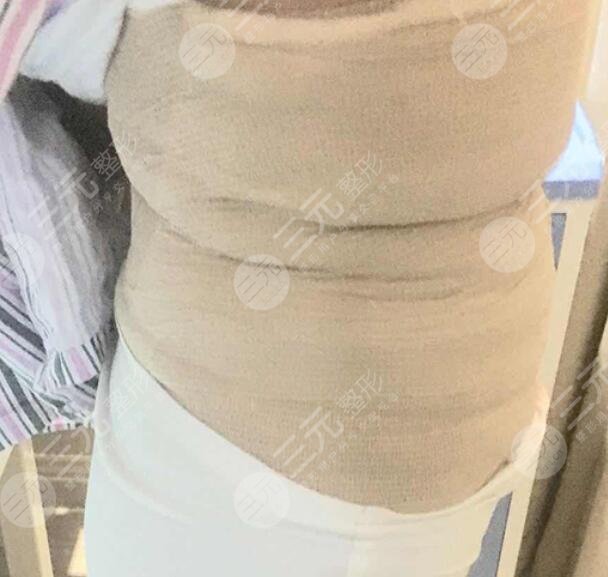 欧洲之星火凤凰纤体溶脂塑形案例后2天